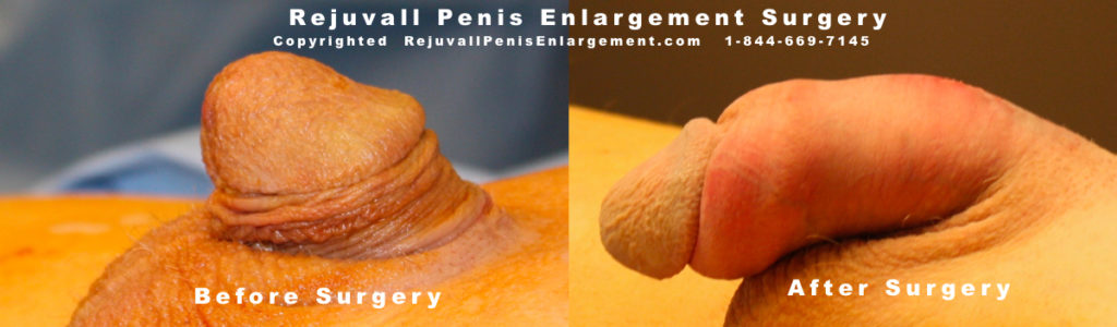 Penis enlargement surgery before and after india